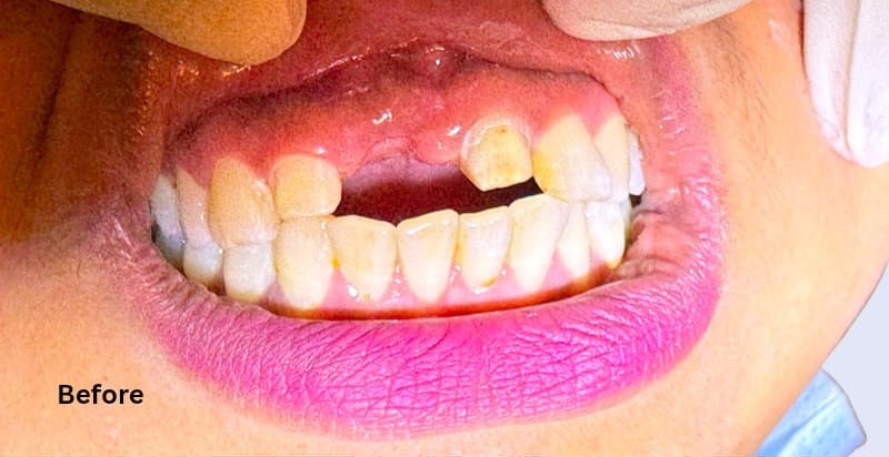 Smile result